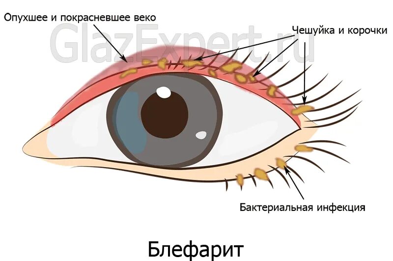 Блефарит конъюнктивит ячмень. Блефарит утолщение века. Воспаление ресничного края. Ресничный край века