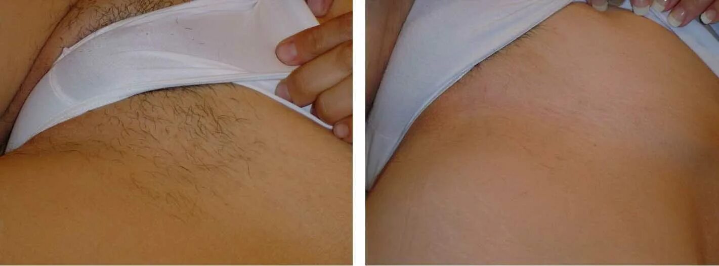 лазерная эпиляция глубокого бикини отзывы фото. лазерная эпиляция глубокого бикини отзывы фото. лазерная эпиляция бикини. глубокое бикини депиляция лазер. элос эпиляция зона бикини.