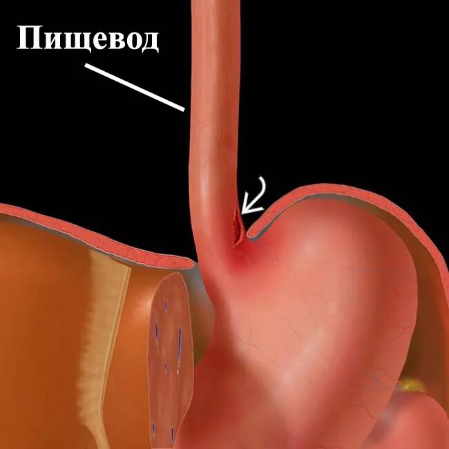 Кровотечение из желудка пищевода