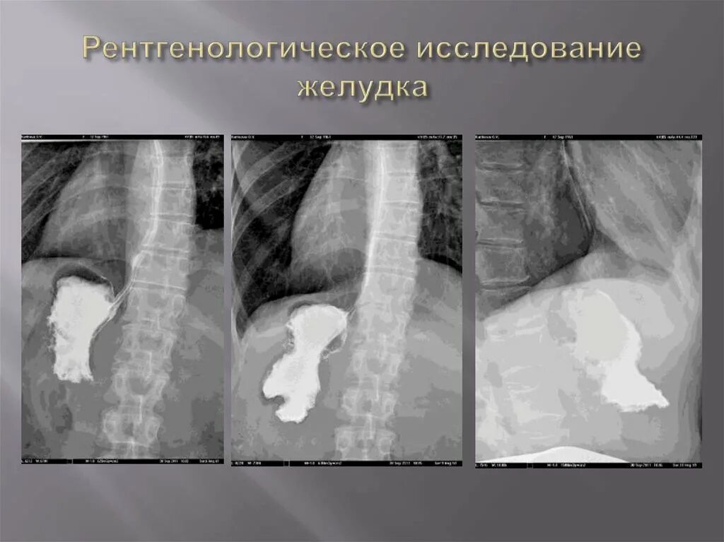 Пищевода с барием. Рентген исследование ЖКТ. Рентгеноскопия желудка с барием. Контрастирование желудка рентген. Рентген исследование желудка с барием.