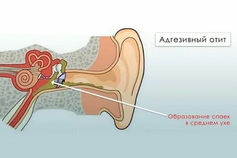 Почему воспаление среднего уха