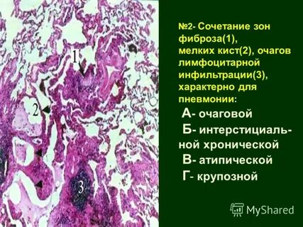 Инфильтрация стромы лимфоцитами