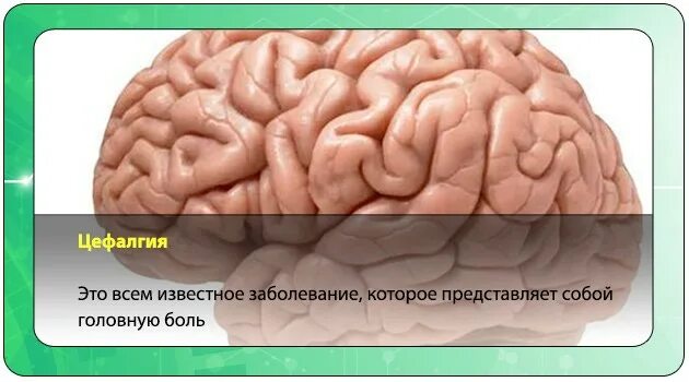 Цефалгия. Цефалгия головного. Цефалгия головного мозга симптомы. Мигренозная цефалгия.