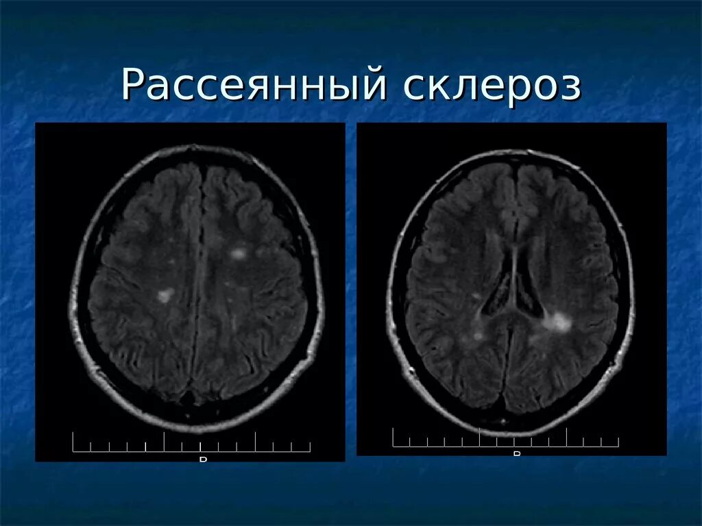 Рассеянный склероз демиелинизация. Демиелинизация головного мозга мрт. Демиелинизирующие заболевания головного мозга кт. Демиелинизирующие заболевания головного мозга на мрт. Признаки демиелинизирующего поражения