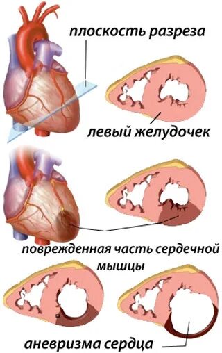 Тромб в желудочке