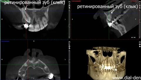 Сколько зуб кт