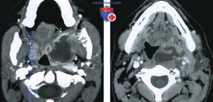 Паратонзиллярный абсцесс кт. Парафарингеальный абсцесс кт. Паратонзиллярный абсцесс рентген. Кт при паратонзиллярный абсцесс. Кт миндалин