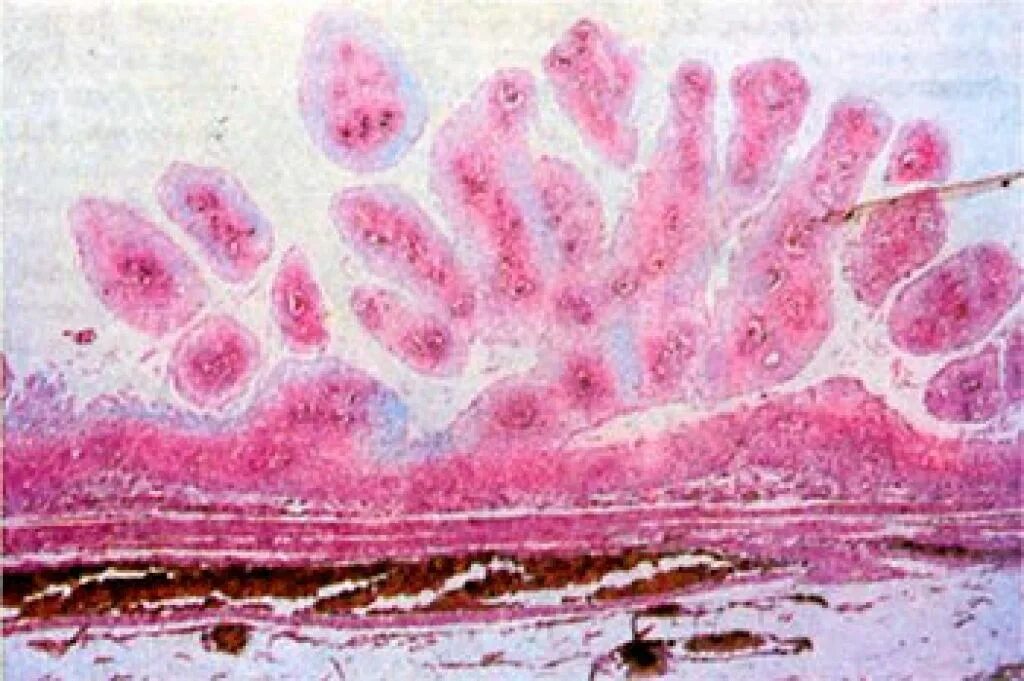 Плоскоклеточная папиллома гистология. Плоскоклеточная папиллома кожи гистология. Плоскоклеточная кондилома гистология. Плоскоклеточная папиллома полости рта гистология. Рак головки члена
