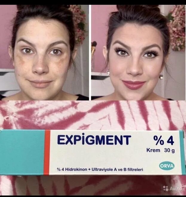 Крем expigment 4 отзывы. Expigment от пигментных пятен. Экспигмент крем до и после. Expigment крем от постакне. Expigment от веснушек.