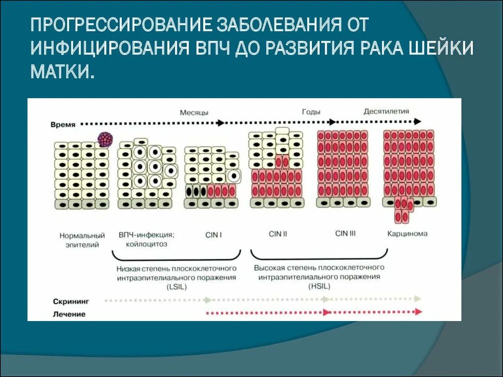 Вирус папилломы человека стадии развития. Развитие рака шейки