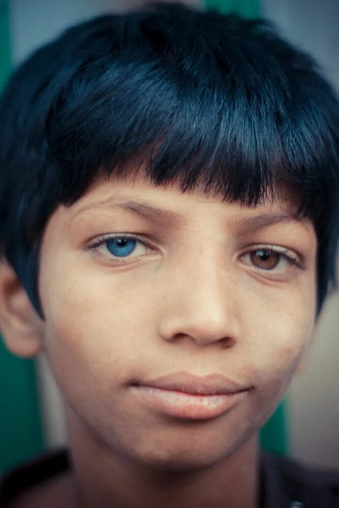 Heterochromia Iridum. Гетерохромия голубой. Разноцветные глаза. Глаза разного цвета.