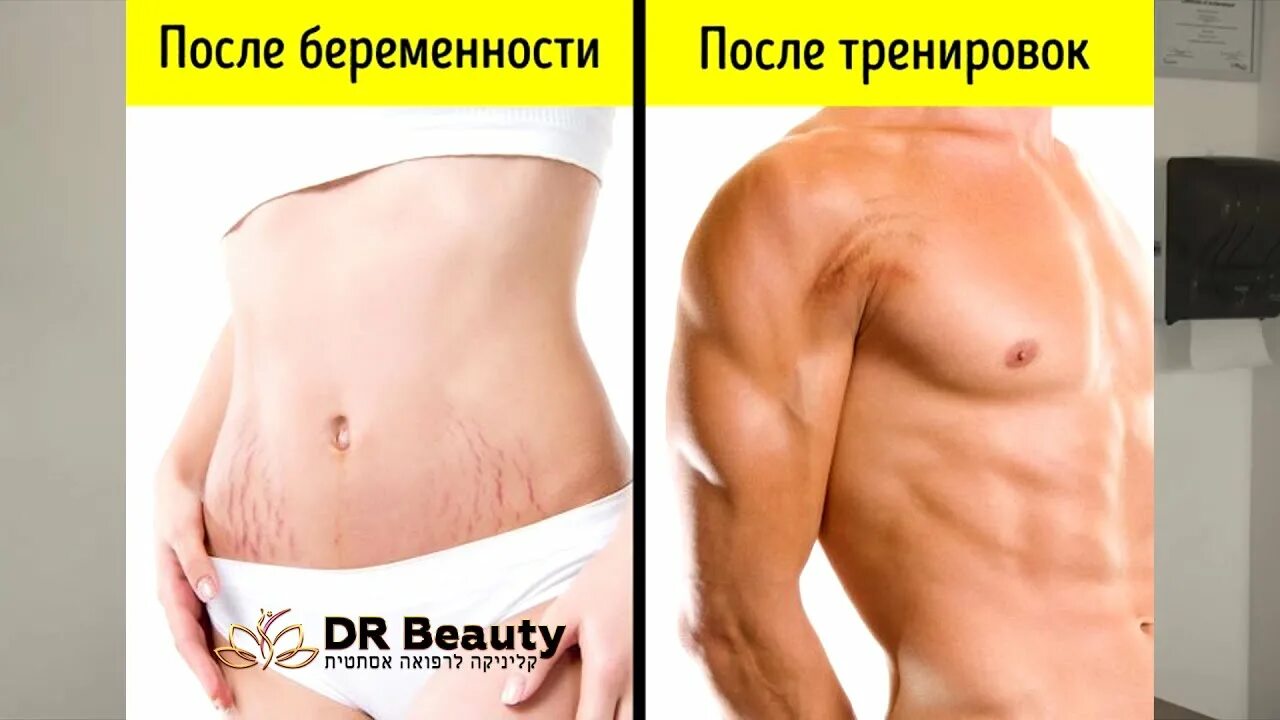 Растянутая кожа что делать