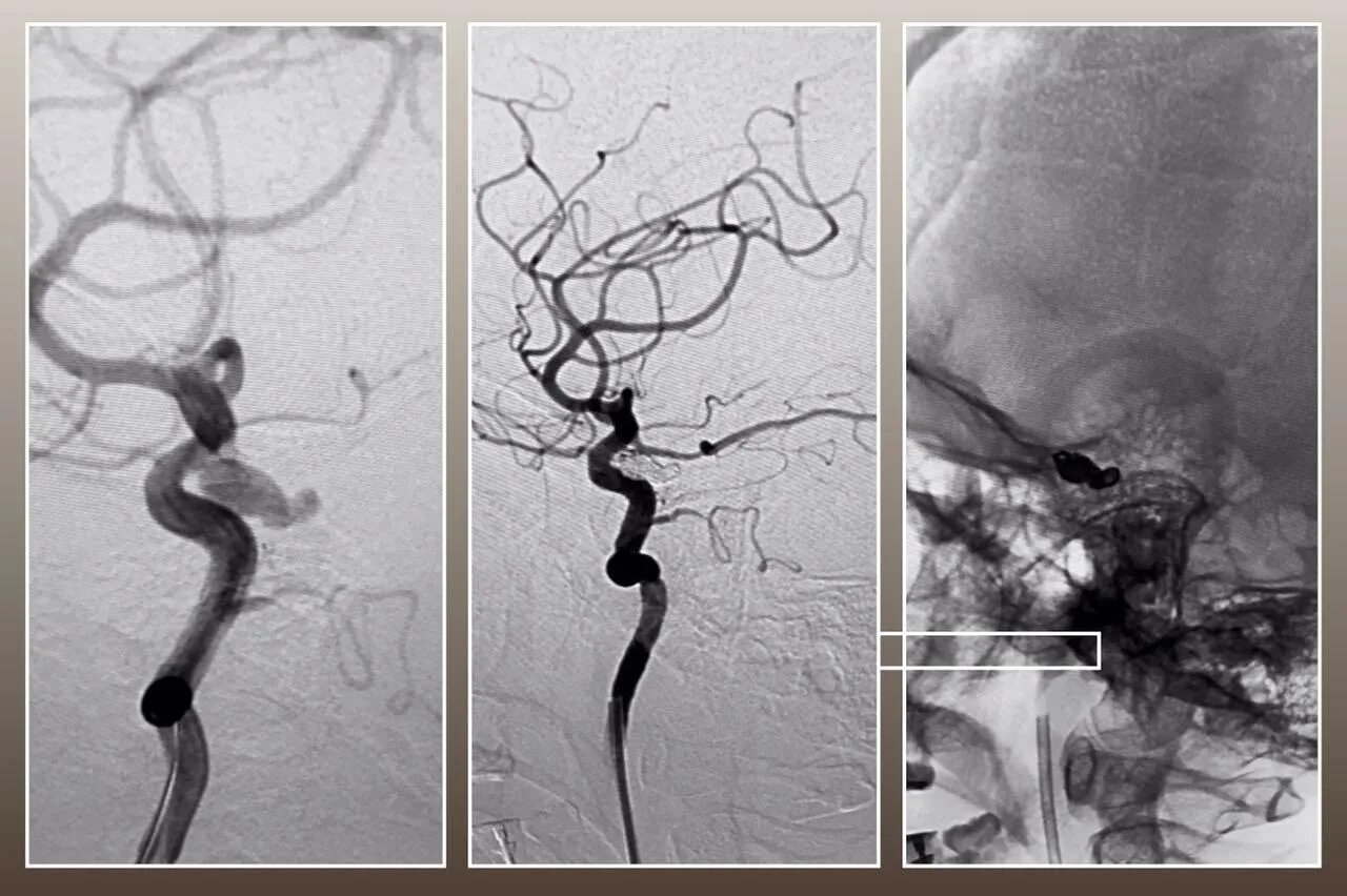 Эндоваскулярная операция аневризмы головного. Эндоваскулярная эмболизация сосудов головного мозга. Эндоваскулярная окклюзия аневризмы. Эндоваскулярная хирургия аневризм артерий головного мозга ОПХ.