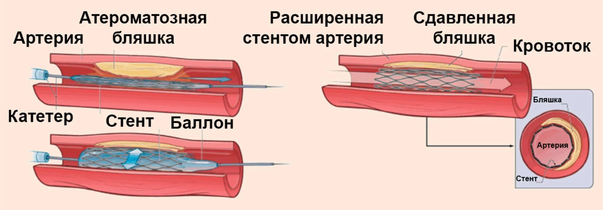 Что такое церебральный атеросклероз. Причины атеросклероза сосудов. виды кровеносных сосудов.