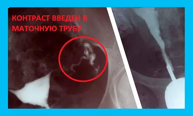 гистеросальпингография спайки. гистеросальпингография двурогая матка. снимок непроходимости маточных труб. гидросонография маточных труб. метросальпингография гистеросальпингография.