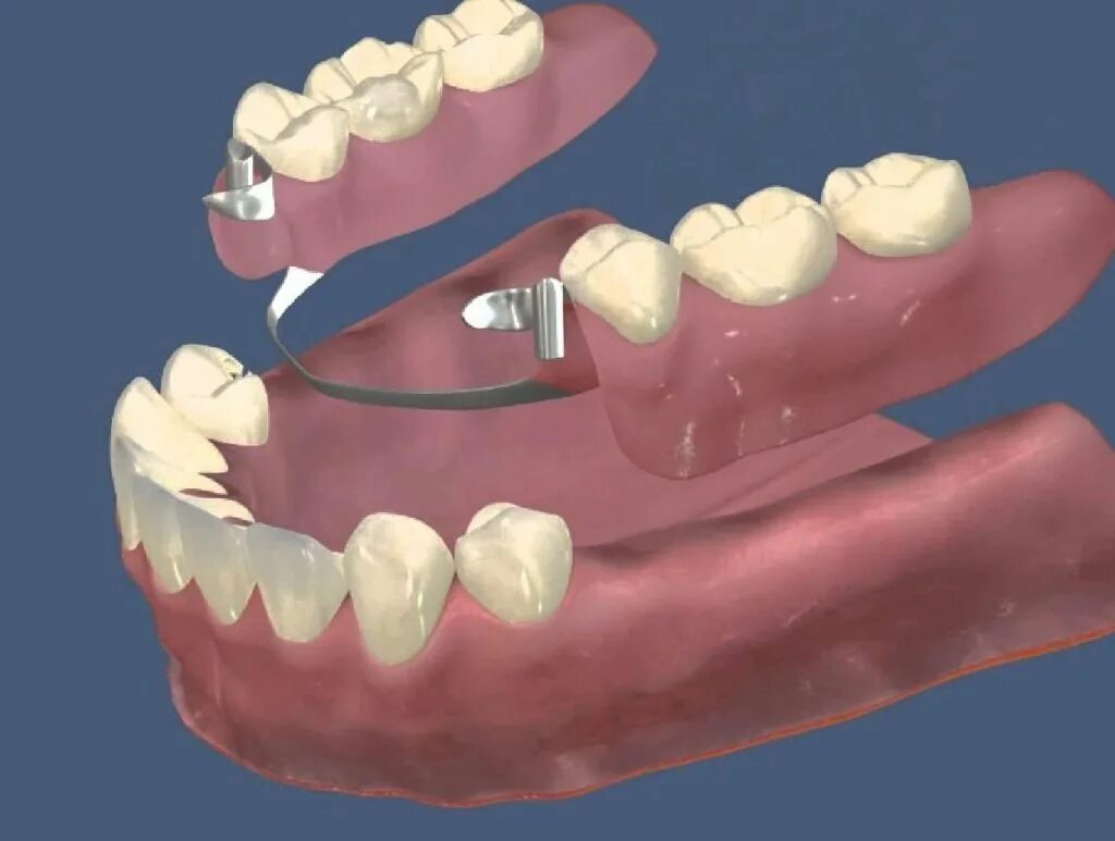 Бюгельный протез с Замковой фиксацией. Нижний замковый бюгельный протез. Бюгельный протез жевательных зубов. Бюгельный протез (1 челюсть)+кламмер. Поставить бюгельный протез