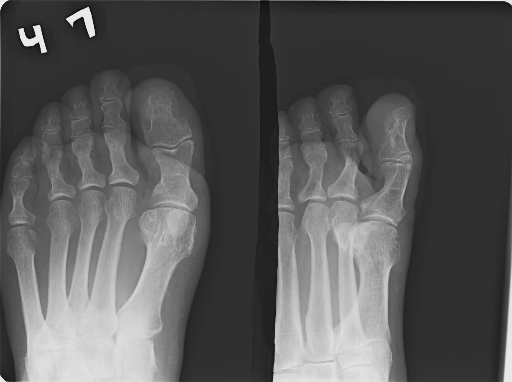 Остеомиелит 1 плюсневой кости. Остеомиелит ногтевой фаланги 1 пальца стопы. Остеомиелит пальцев стопы рентген. Остеомиелит фаланги пальца рентген. Ногтевая фаланга ноги