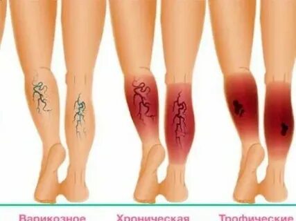 Тропическая нога