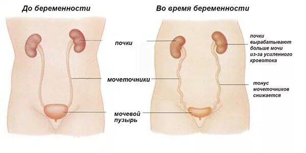 Мочеточник беременность