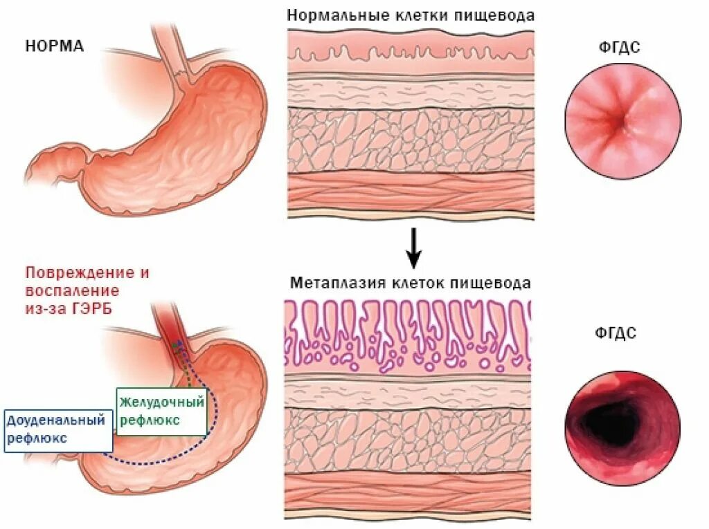 Клетки пищевода. Пищевод Барретта метаплазия эпителия. Пищевод Баррета патогенез.