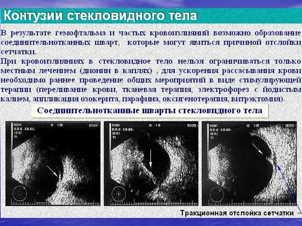 Контузионные изменения кости. УЗИ глаза отслойка сетчатки. Отслойка стекловидного тела глаза УЗИ. Шварты стекловидного тела на УЗИ.