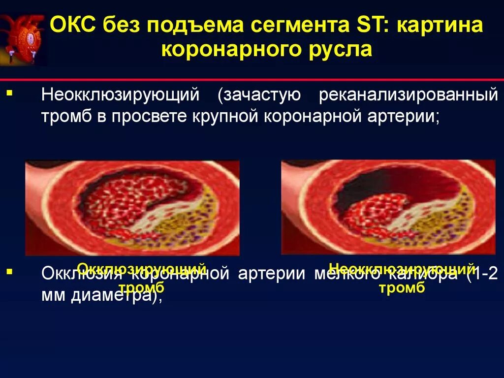 Характеристики окс. Окс без подъема сегмента. Патоморфология острого коронарного синдрома. Острый коронарный синдром (Окс). Острый коронарный синдром презентация.