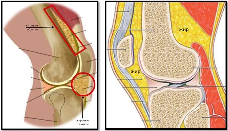 Отек гоффа коленного сустава. Коленный сустав в разрезе. Жир на внутренней стороне колена.