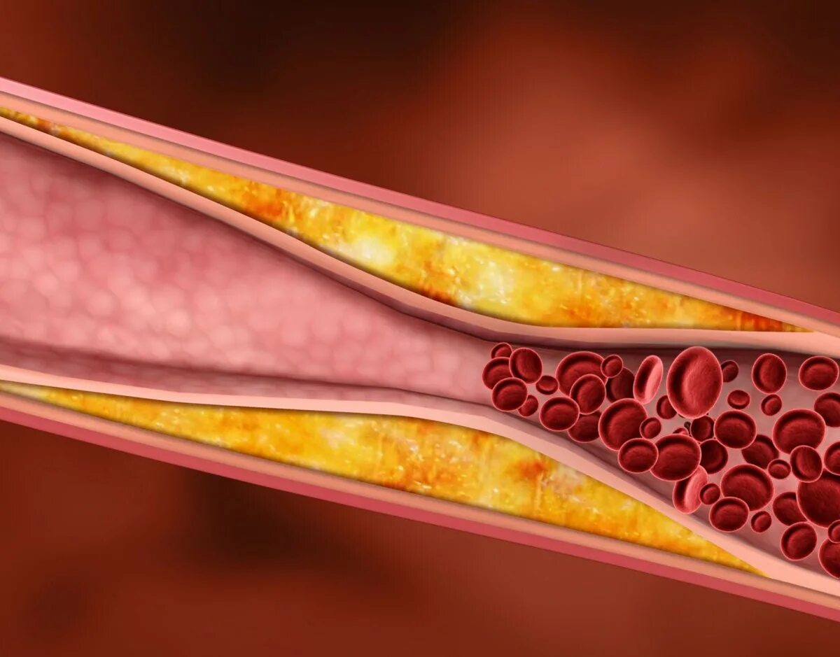 Холестериновые бляшки на теле. Как очистить сосуды от холестериновых тромбов