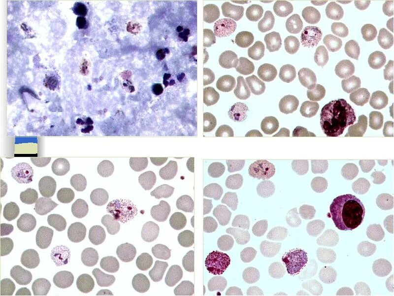 Для диагностики малярии забор крови осуществляют. Малярийный плазмодий мазок крови. Малярия мазок крови микроскопия. Малярийный плазмодий Романовский Гимзе. Кровепаразиты малярия.