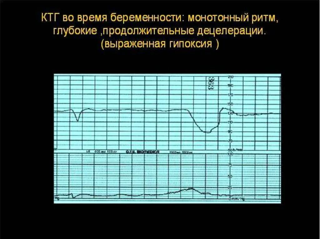 Подозрительное ктг. Подозрительное ктг
