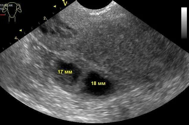 Эндометриоидная киста на УЗИ. Эндометриома яичника на УЗИ. Субмукозная миома матки УЗИ. Можно перепутать беременность с кистой
