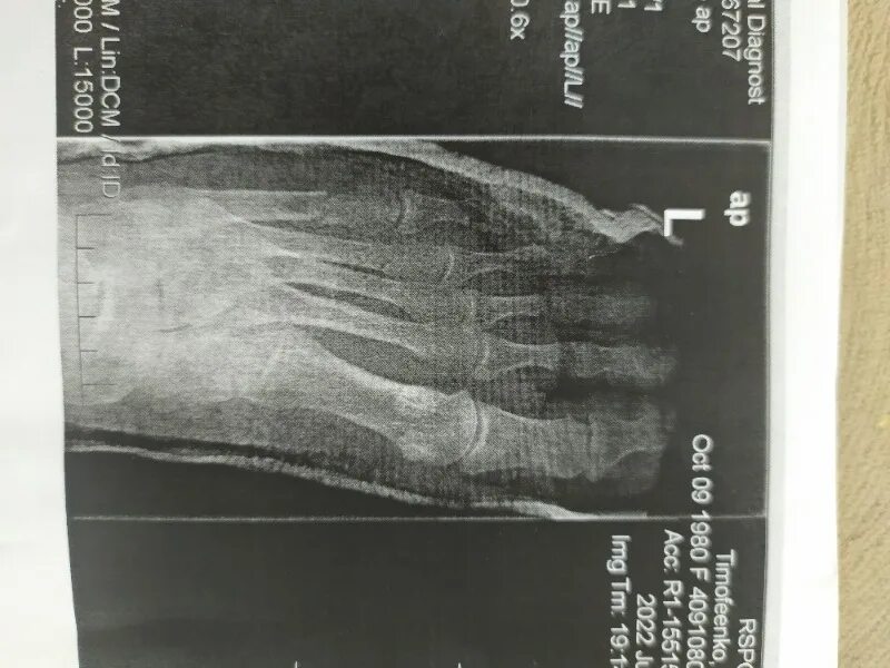 Мкб 10 плюсневая кость. Осколочный перелом плюсневой кости. Рентген 5 плюсневой кости. Перелом 5 плюсневой кости кисти. Перелом 5 плюсневой кости.