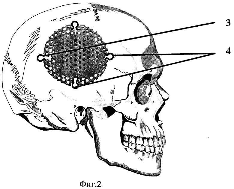 Череп разрыв. ПОСТТРЕПАНАЦИОННЫЙ костный дефект черепа. Пластика дефектов черепа (краниопластика). Незамещенный дефект свода черепа. Закрытие костного дефекта костей черепа.
