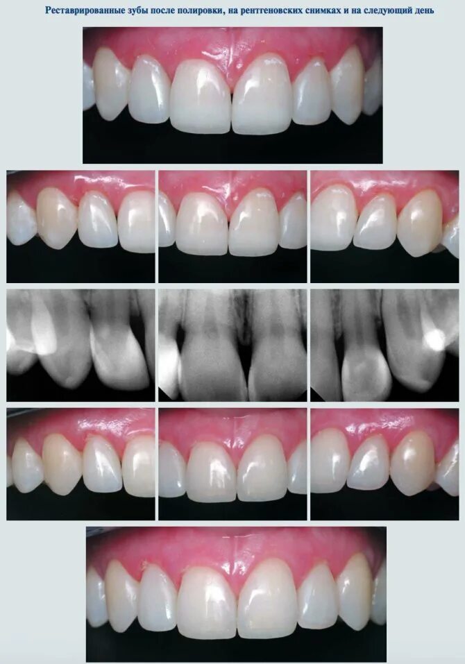 Цена композитной реставрации. Композитные виниры кариес. Восстановление формы зуба. Художественное наращивание зубов.
