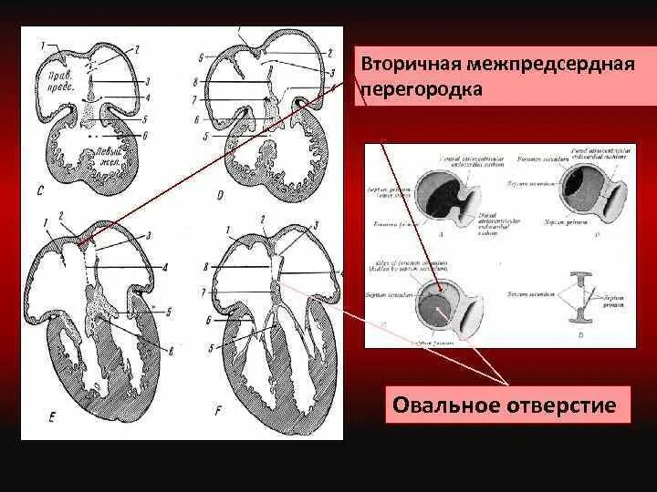 Аневризма перегородки у ребенка. Операция аневризма межпредсердной перегородки. Первичная межпредсердная перегородка. Строение межпредсердной перегородки. Межпредсердная перегородка дефект.