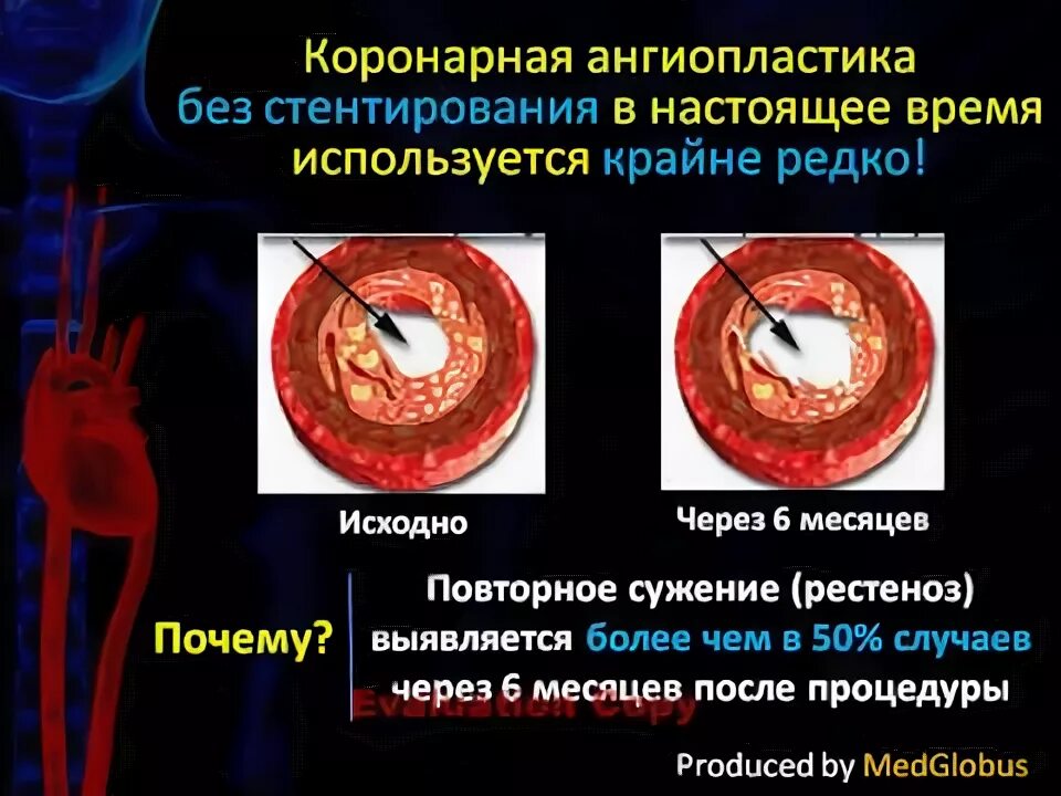 Можно ли кофе после стентирования