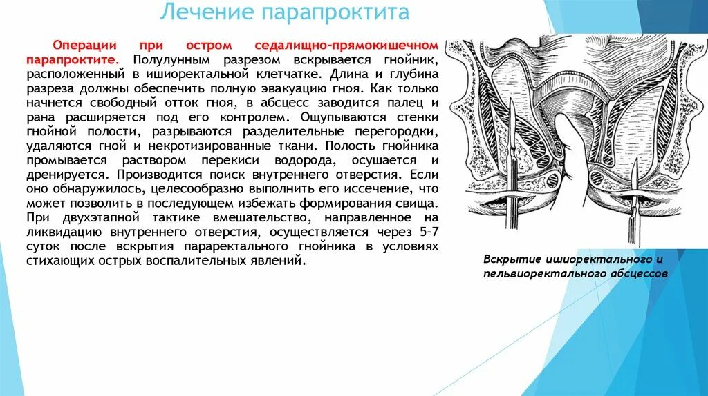 Лечение трещин кишки. Острый Гнойный ишиоректальный парапроктит. Острый парапроктит принципы лечения. Ретроректальный парапроктит операция. Воспаление параректальной клетчатки.