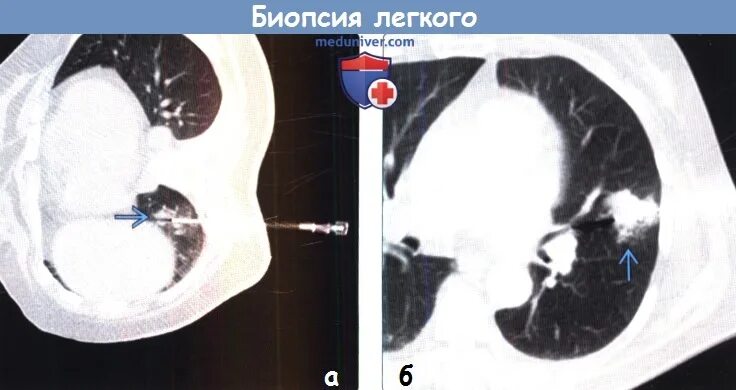 Как делают биопсию легких. Трансторакальная биопсия легкого. Биопсия легких под кт контролем. Осложнения после биопсии легких. Пункция легкого под контролем кт.