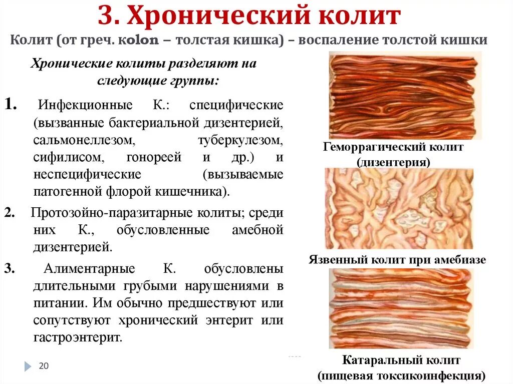 Симптомы хронического колита кишечника у взрослых. Хронический колит симптомы. Хронический колит причины.