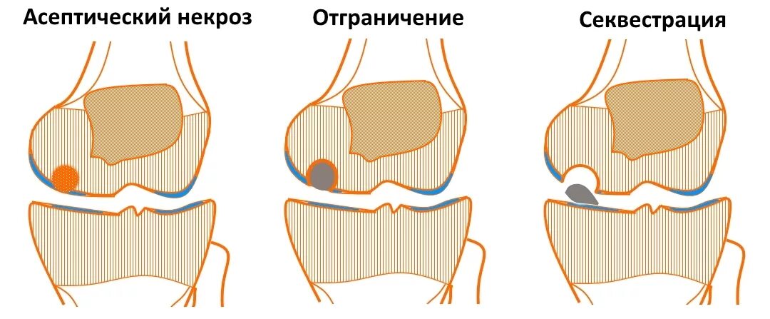 Асептический некроз мыщелка бедренной. Асептический некроз мыщелка бедренной кости кт. Болезнь Кенига коленного сустава кт. Болезнь Кёнига рассекающий остеохондрит. Асептический некроз мыщелка бедра.