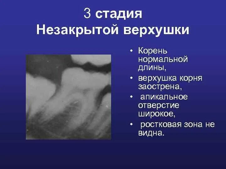 Стадии формирования корня зуба постоянного. Стадия незакрытой верхушки корня.