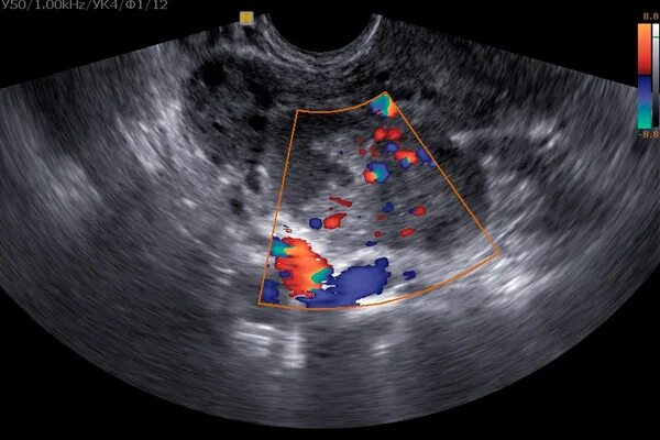 Цветное допплеровское картирование кисты яичника. Злокачественная опухоль яичника на УЗИ. Муцинозные опухоли яичников