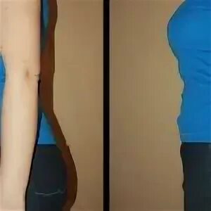 Женщина надорвала живот. Пупочная грыжа симптомы. Послеоперационная грыжа аппендикс. Женщина надорвала живот. Женщина надорвала живот.