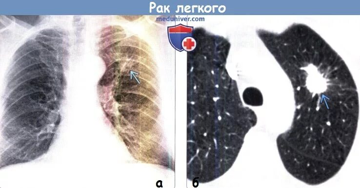 80 процентов поражение