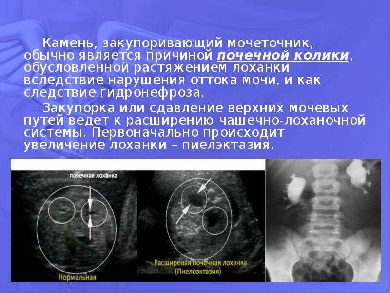 Дилатация мочеточника. Дилатация мочевых путей. Почечная колика лучевая диагностика. Дилатация верхних мочевых путей. УЗИ при почечной колике.