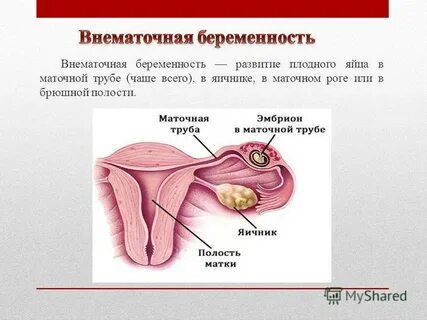 Одной трубой рожать можно