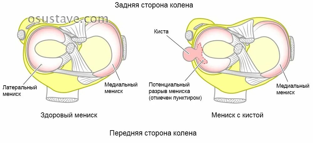 Передний рог коленного сустава. Задний Рог мениска коленного сустава. Повреждение рога мениска коленного сустава. Надрыв переднего рога медиального мениска. Мениск коленного сустава задний рожок.