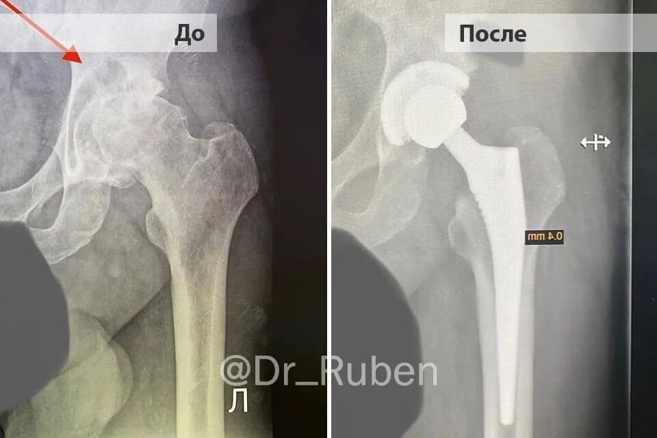 Эндопротез сустава мкб 10. Тазобедренный эндопротез. трохантерит тазобедренного сустава. эндопротез тазобедренного сустава страйкер.