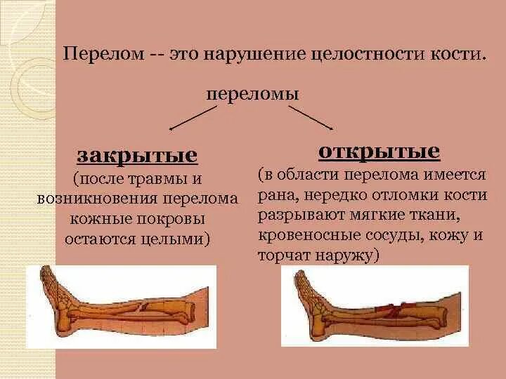 Перелом кости может быть каким. Симптоматика перелома кости. Переломы Косте конечностей. Открытые и закрытые передома.