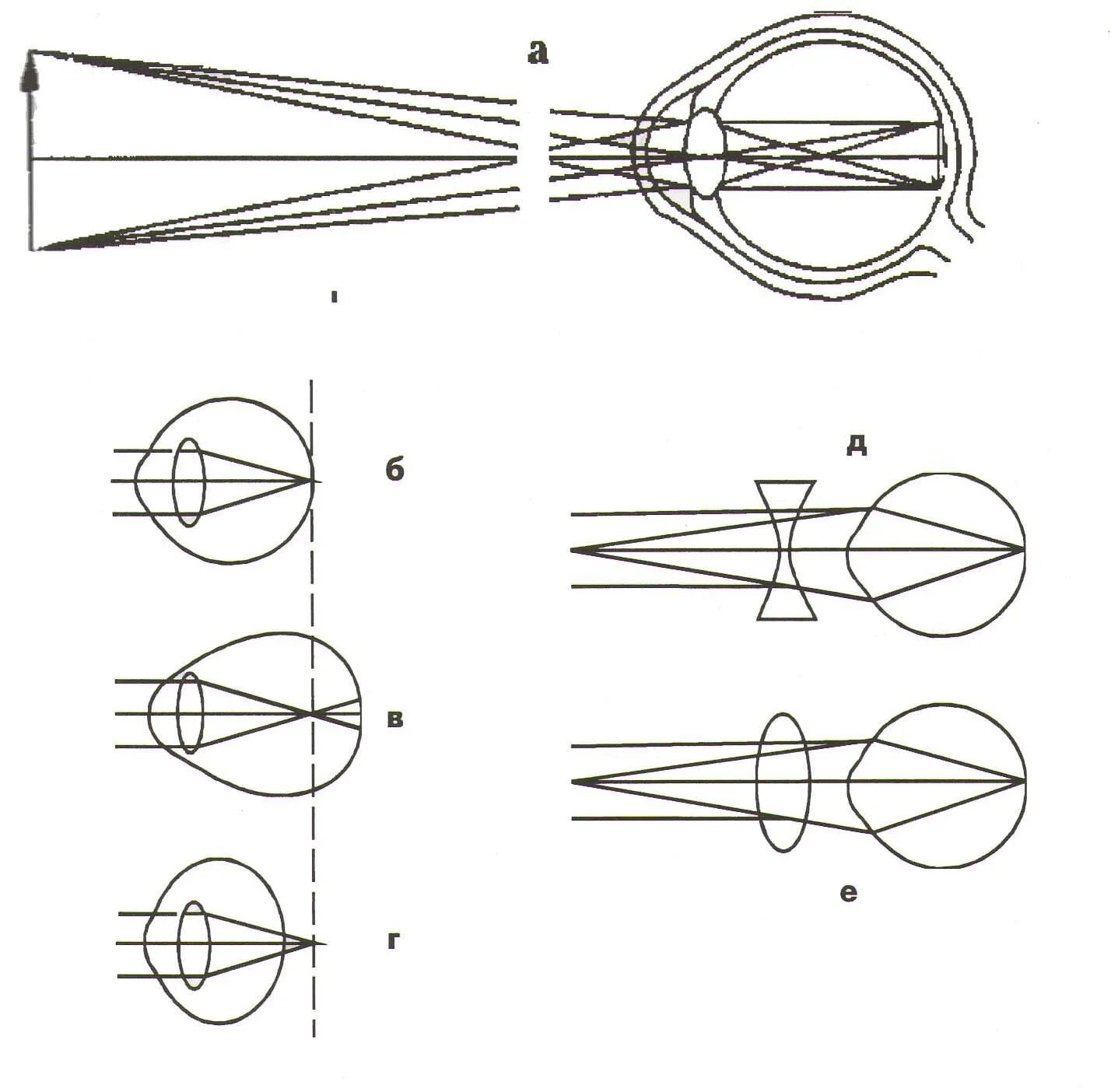 Глаз очки дальнозоркость и близорукость. Близорукость ход лучей в глазе. Ход лучей близорукость и дальнозоркость. Оптическая схема глаза близорукость. Ход лучей в близоруком глазу.